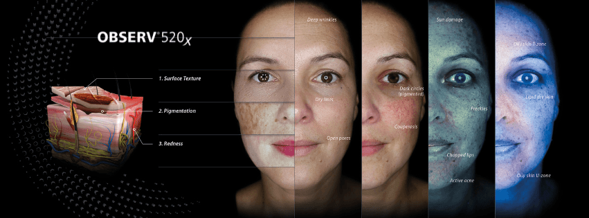 Observ 520x Skin Analysis